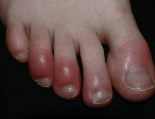 Chilblains