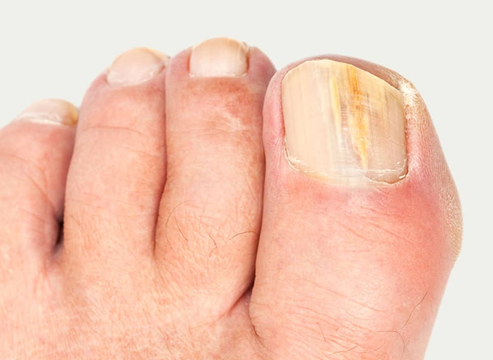 7. Colorful Fungal Nail Treatment - wide 6