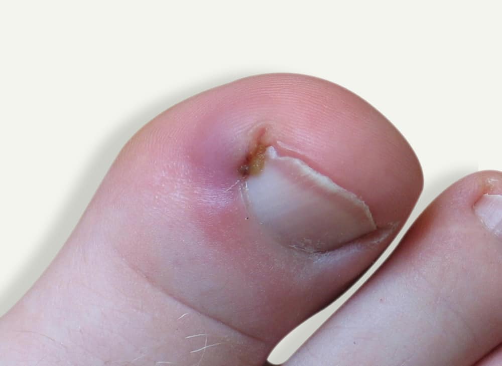 How do I prevent ingrown toenails? - Davenport House Clinic